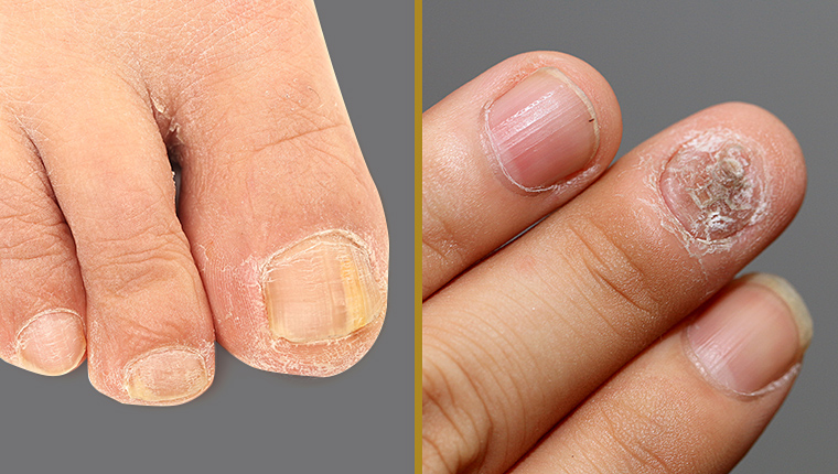 Nail Infection
